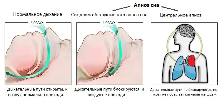 Апноэ после инсульта