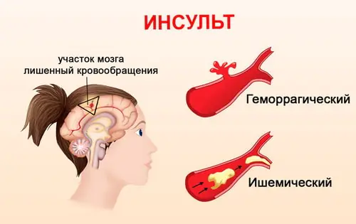 постоянная сонливость после инсульта