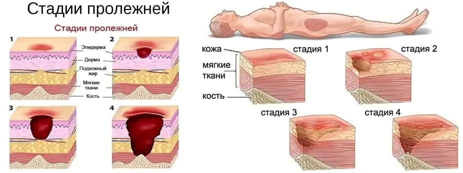 Причины образования пролежней
