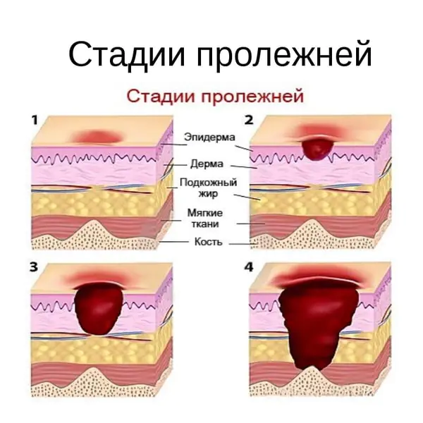 пролежни