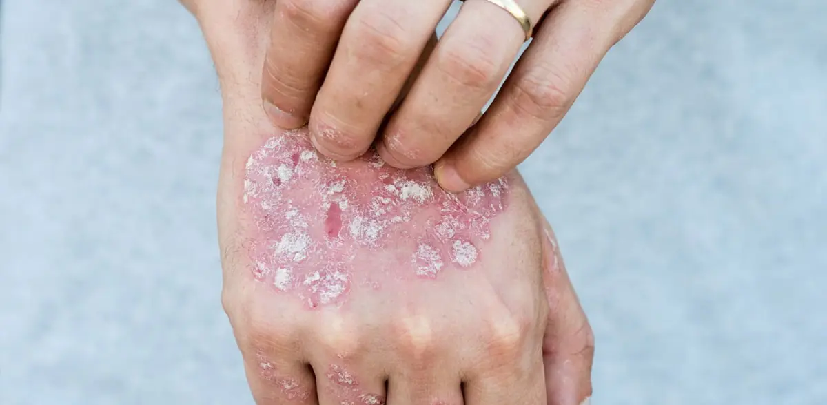 psoriaz-i-alczgejmer.jpg