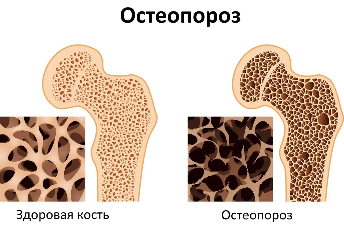 bolezn-hrupkih-kostej.jpg
