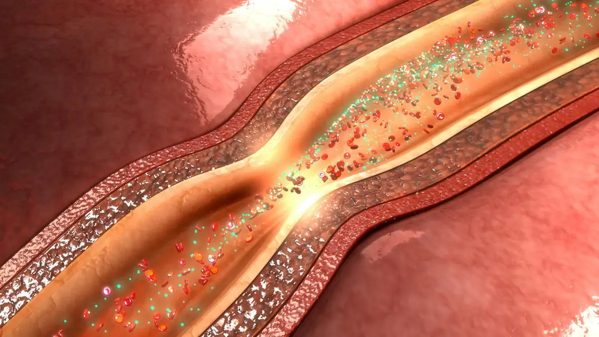 spazm-koronarnoj-arterii.jpg