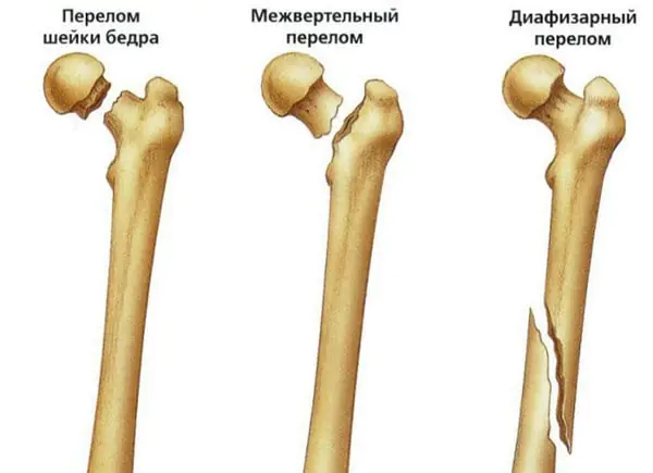 Травма бедренной части